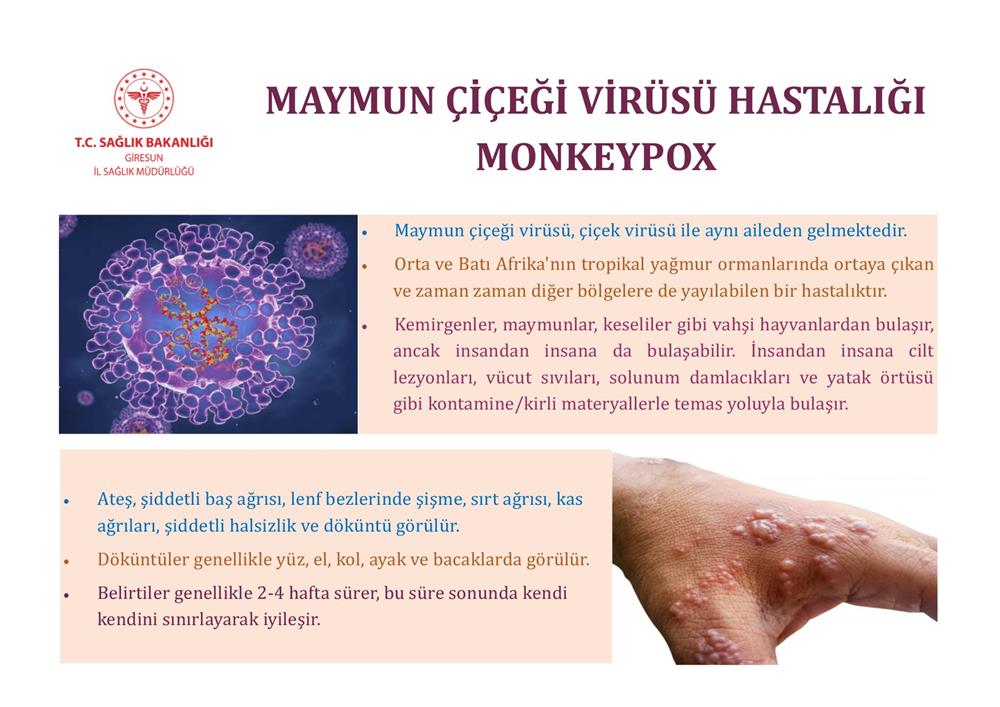 Maymun Çiçeği Virüsü Hastalığı (Monkeypox)